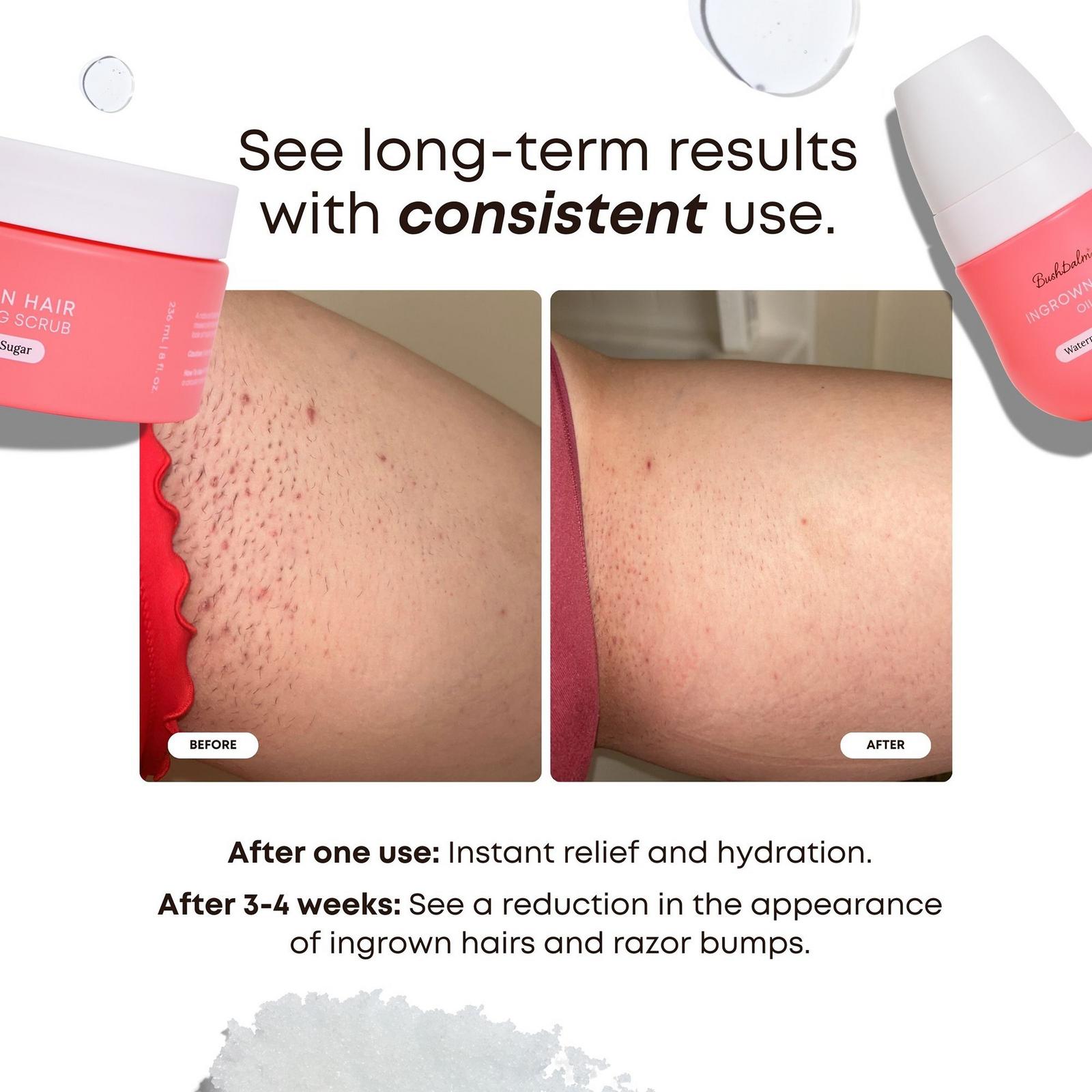 Watermelon Sugar 2 Step Ingrown Hair & Razor Bump Kit