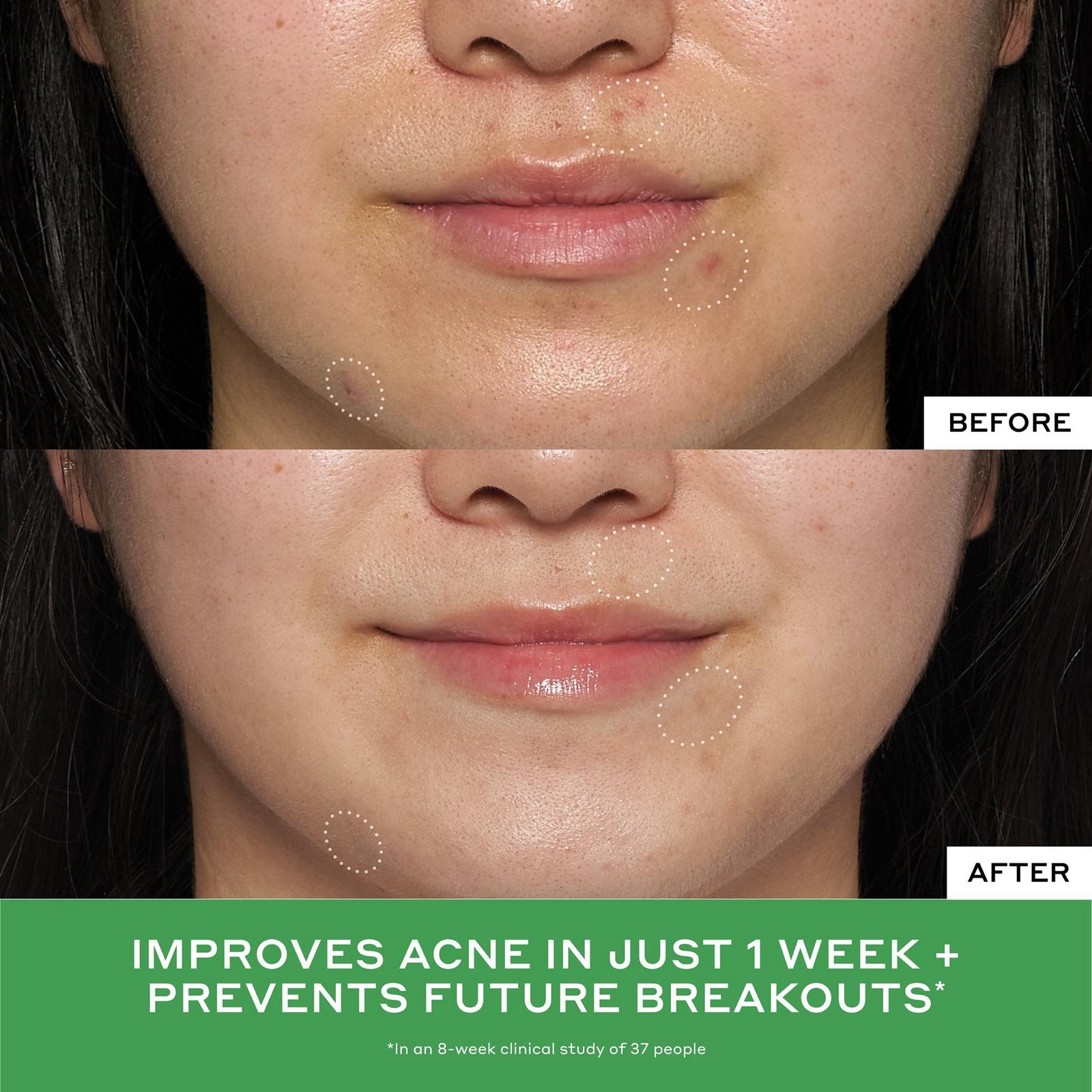 Detox Drops 2% Salicylic Acid Acne Toner
