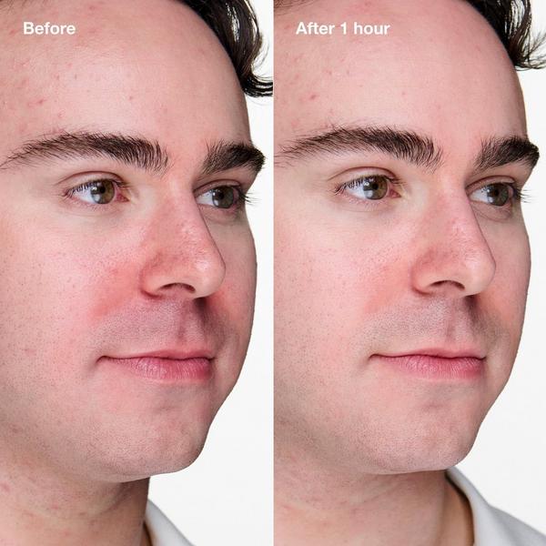 Clinique Acne Solutions Clinical Advanced Clearing Gel with Salicylic Acid #4