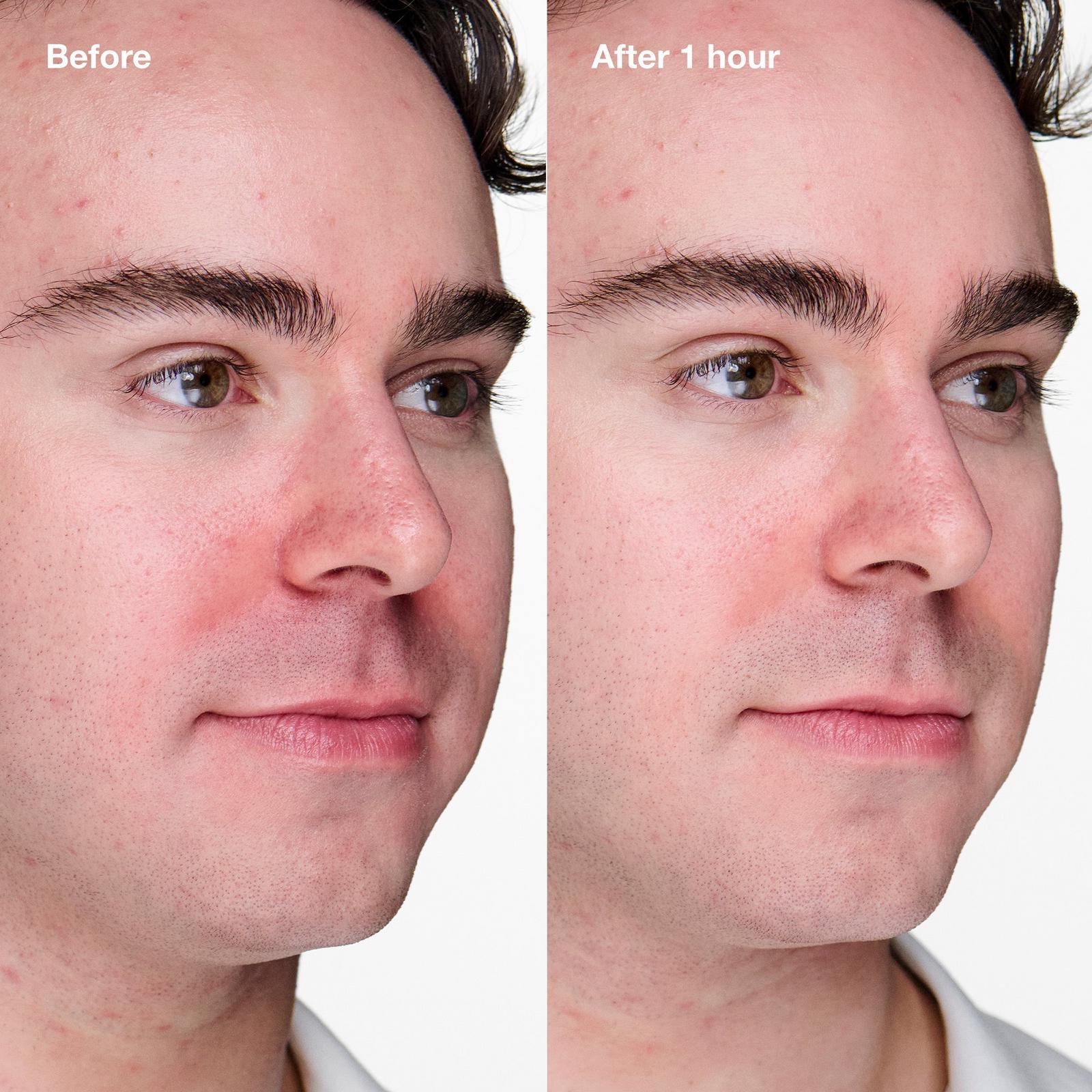 Travel Size Acne Solutions Clinical Advanced Clearing Gel with Salicylic Acid