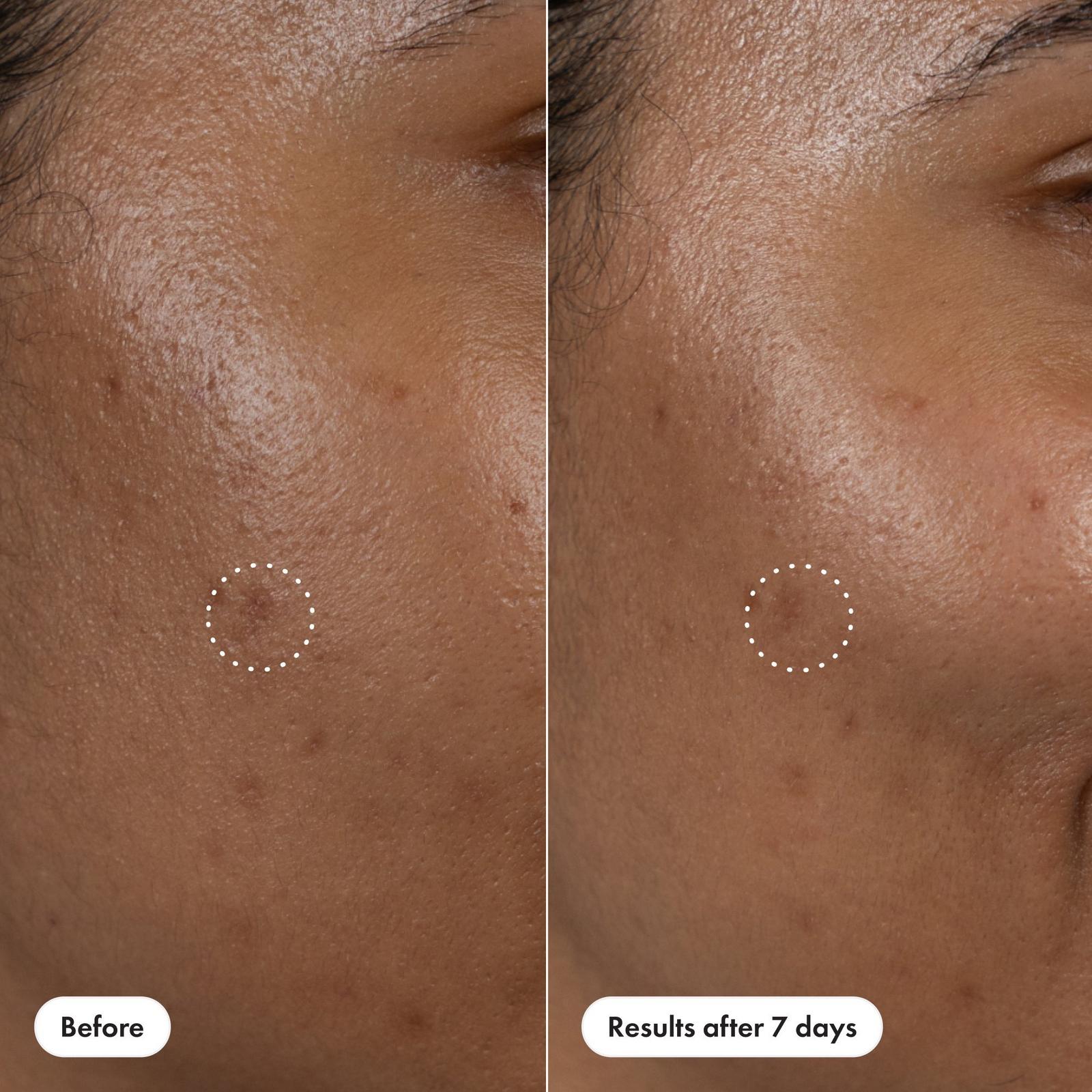 Dark Spot Corrector