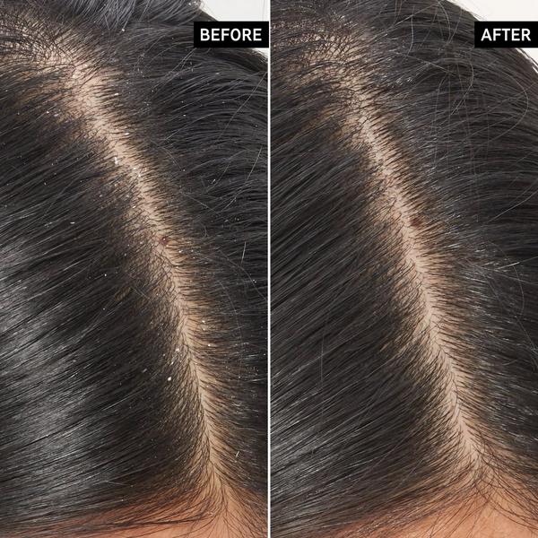 INKEY Salicylic Acid Exfoliating Oily Scalp Treatment #6