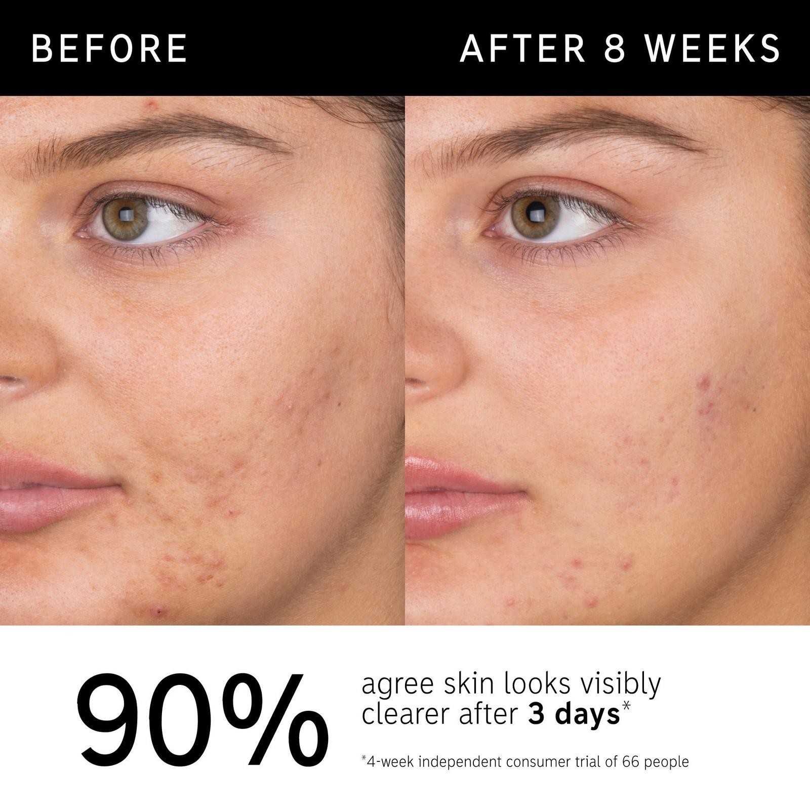 Salicylic Acid Acne + Blackhead Cleanser