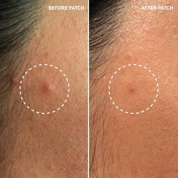 INKEY Hydrocolloid Invisible Pimple Patches + Salicylic Acid #4