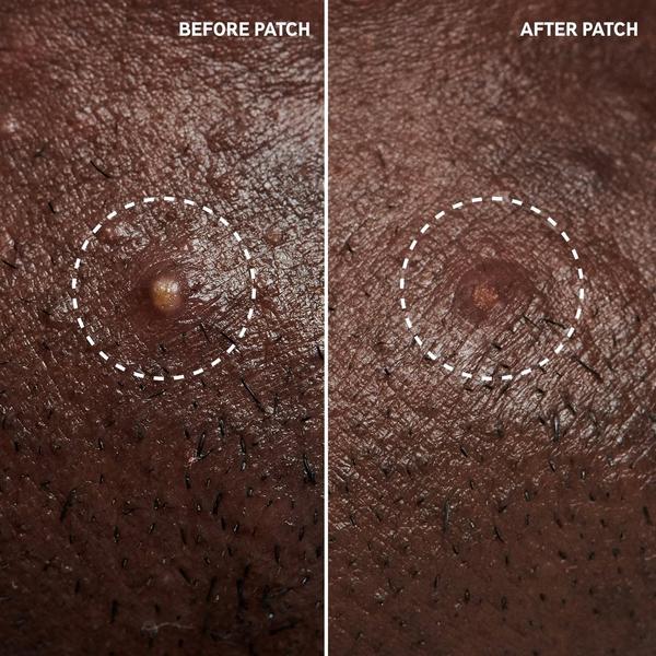 INKEY Hydrocolloid Invisible Pimple Patches + Salicylic Acid #8