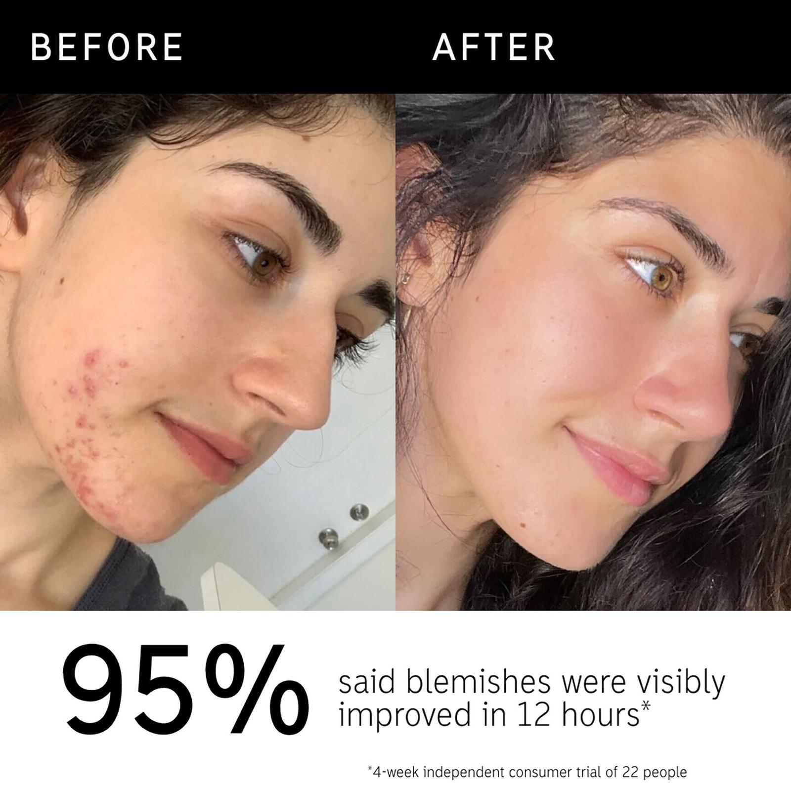 Succinic Acid Acne Treatment