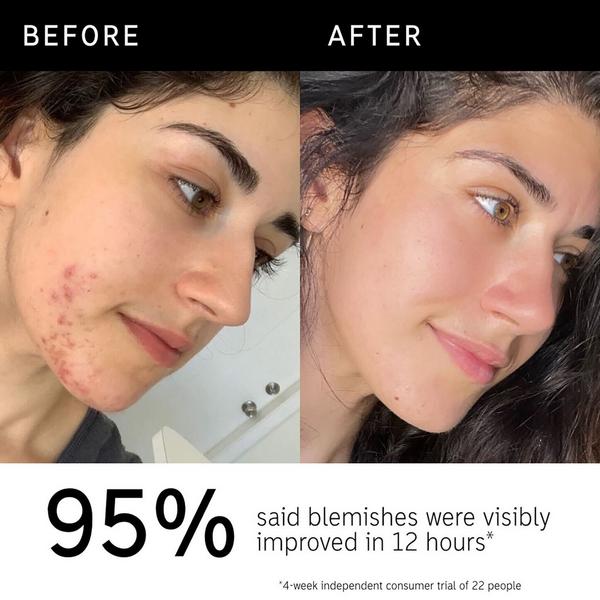 INKEY Succinic Acid Acne Treatment #4