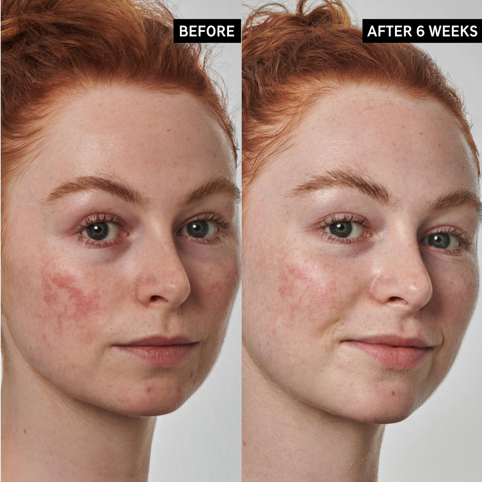 SuperSolutions 10% Azelaic Acid Serum Redness Relief Solution