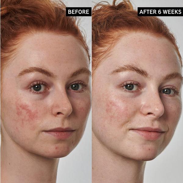 INKEY SuperSolutions 10% Azelaic Acid Serum Redness Relief Solution #4