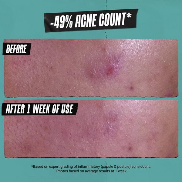 Kiehl's Since 1851 Acne-Treating Cleansing Paste #6