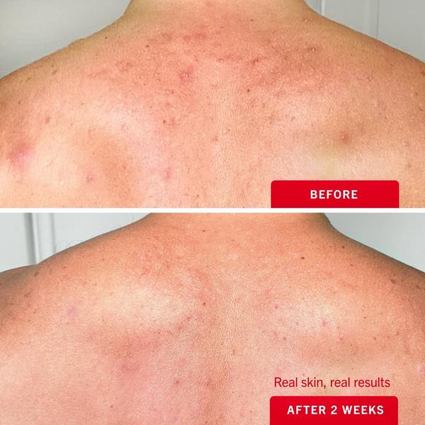First Aid Beauty Body Acne Clearing Mist #4