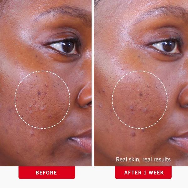First Aid Beauty Acne Clearing Pads 2% Salicylic Acid Acne Treatment #4