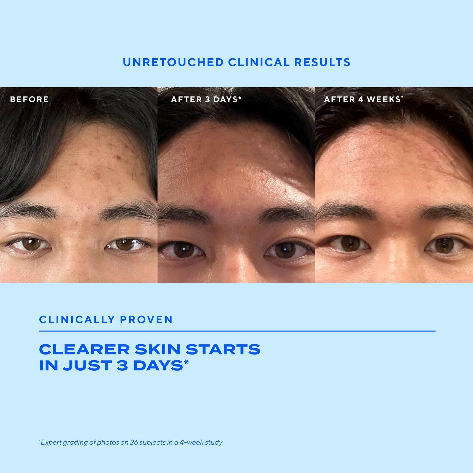 Biome-Balancing Clear & Prevent Acne Treatment Serum