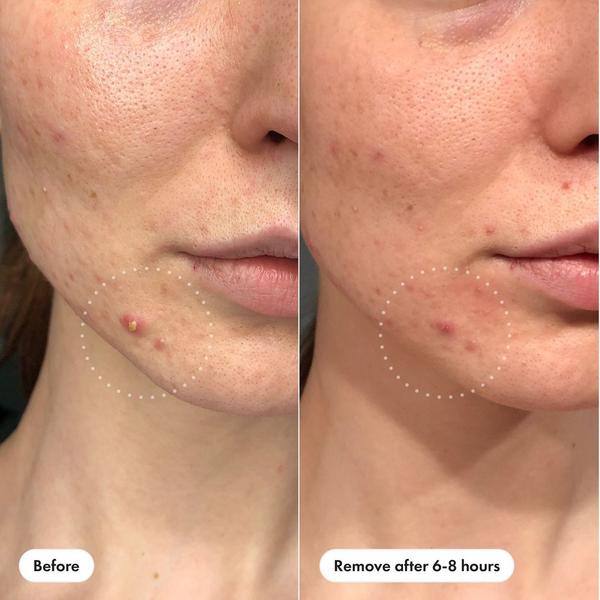 Hero Cosmetics Mighty Patch Invisible+ Daytime Hydrocolloid Acne Pimple Patches #2