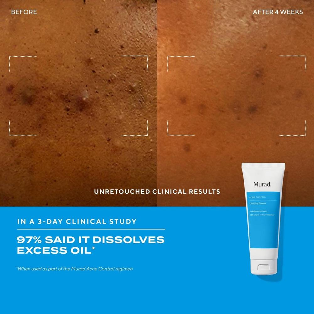 Clear Skin Acne Discovery Starter Kit