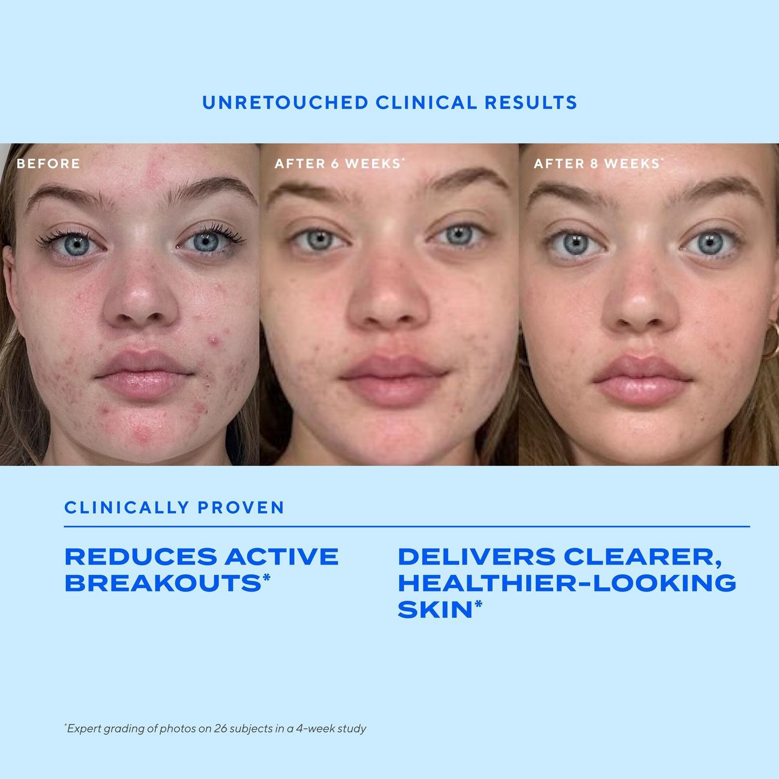 Clear Skin Acne Discovery Starter Kit