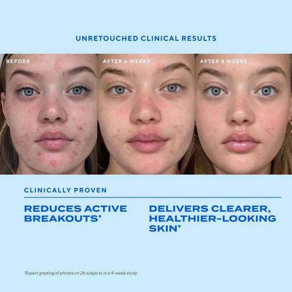 Murad Clear Skin Acne Discovery Starter Kit #5