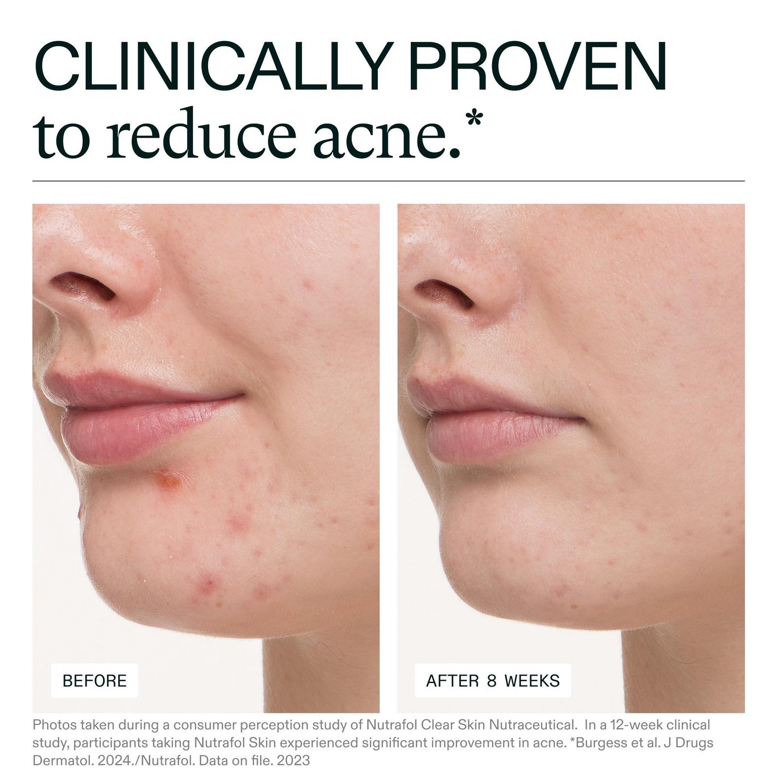 Clear Skin Clinically Proven Supplement for Acne + Breakouts