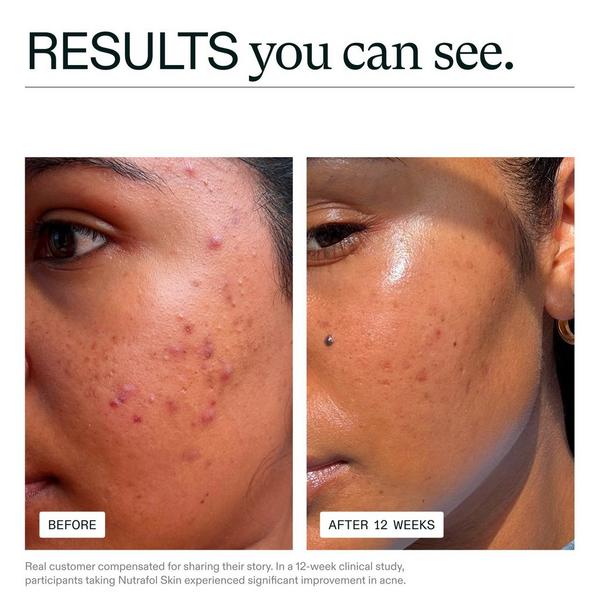 NUTRAFOL Clear Skin Clinically Proven Supplement for Acne + Breakouts #3