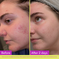 Good Molecules 10% Azelaic Acid Treatment #3