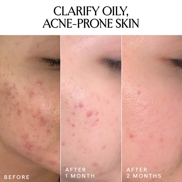 HERBIVORE LAPIS Blue Tansy + Squalane Balancing Facial Oil #5