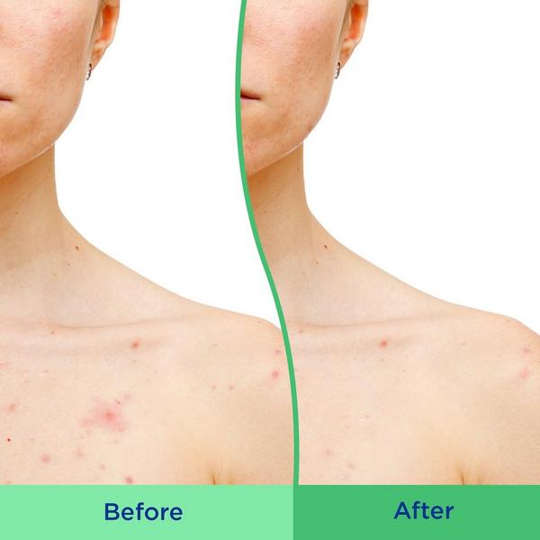 Differin Acne-Clearing Body Scrub #4