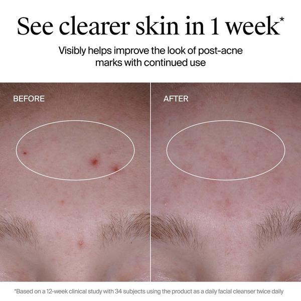 Neutrogena Evenly Clear Acne Cleanser with Salicylic Acid #3