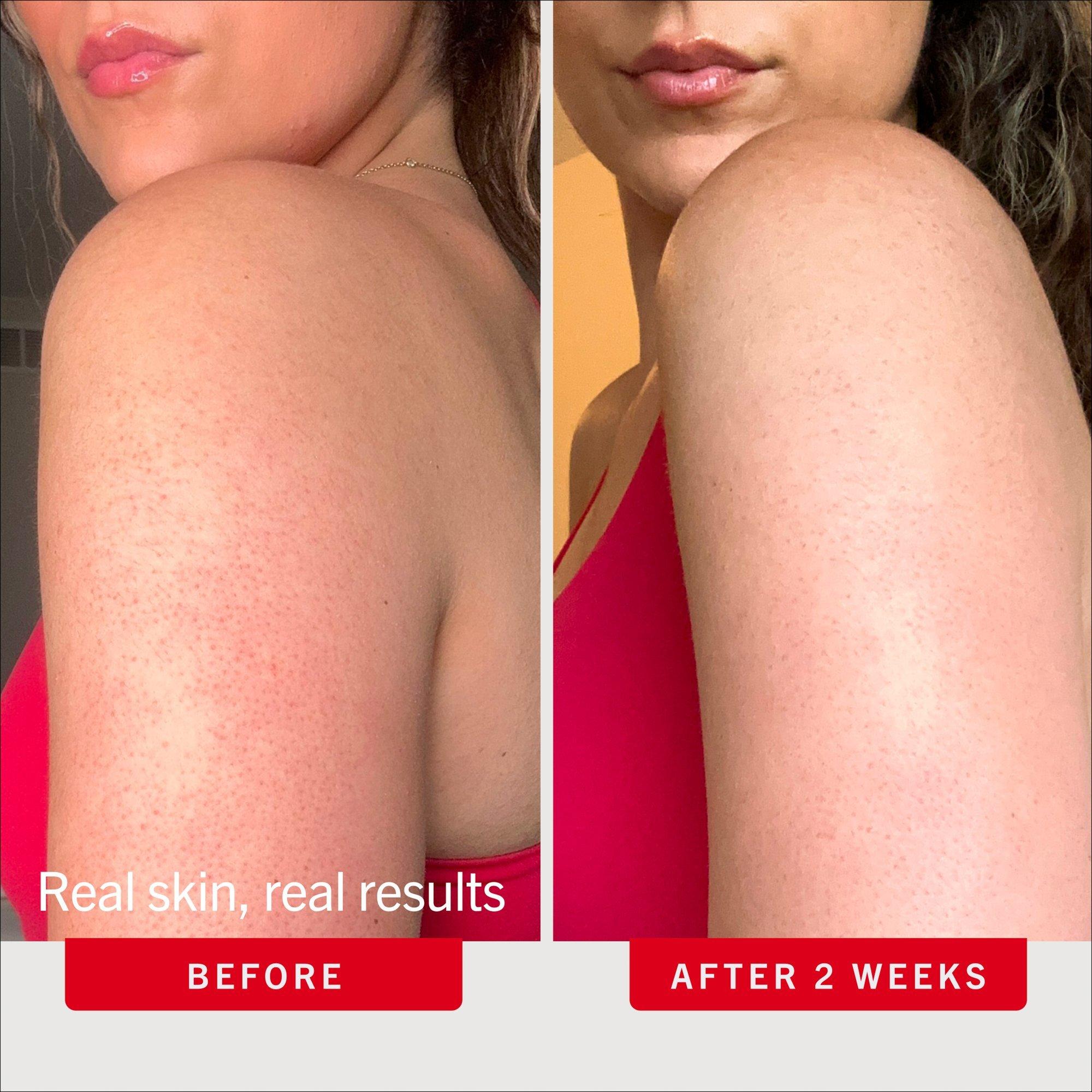 Скраб для тела с 10% AHA First Aid Beauty KP Bump Eraser, дорожный размер — фото 4