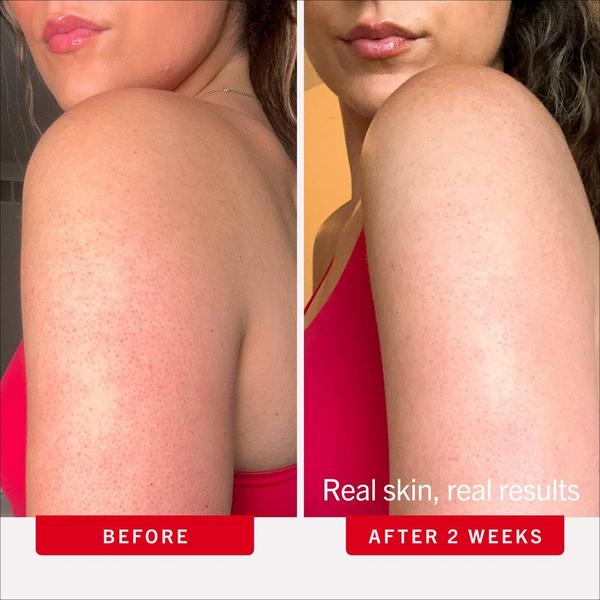 First Aid Beauty KP Bump Eraser Body Scrub with 10% AHA #5