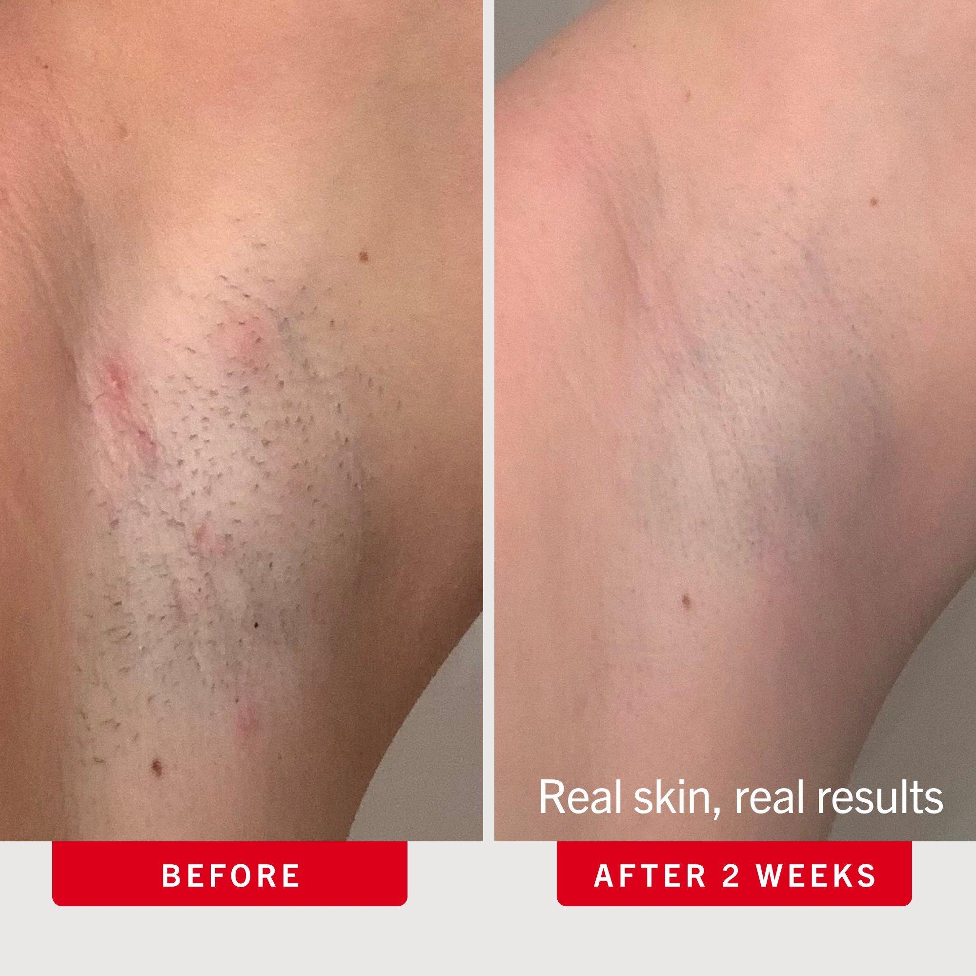 Диски от вросших волос First Aid Beauty с BHA и AHA — фото 4