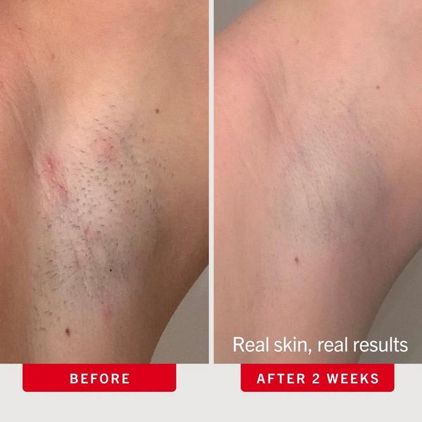 First Aid Beauty Ingrown Hair Pads with BHA + AHA #4