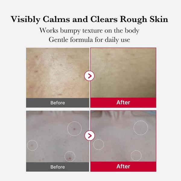 medicube Red Acne Body Peeling Shot #4