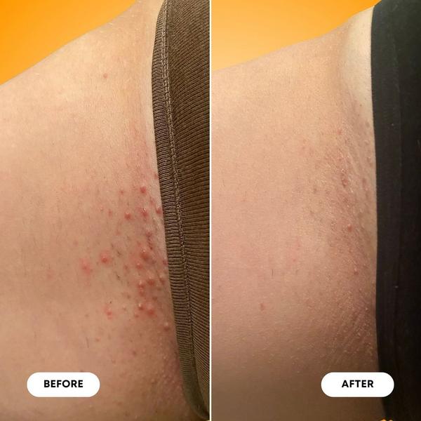 Bushbalm 2 Step Ingrown Hair & Razor Bump Kit #6