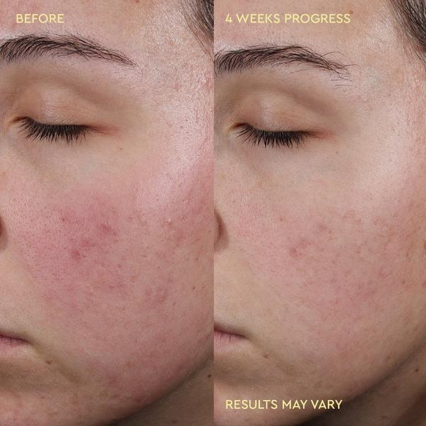 BYOMA Blemish Acne Control Moisturizer #5