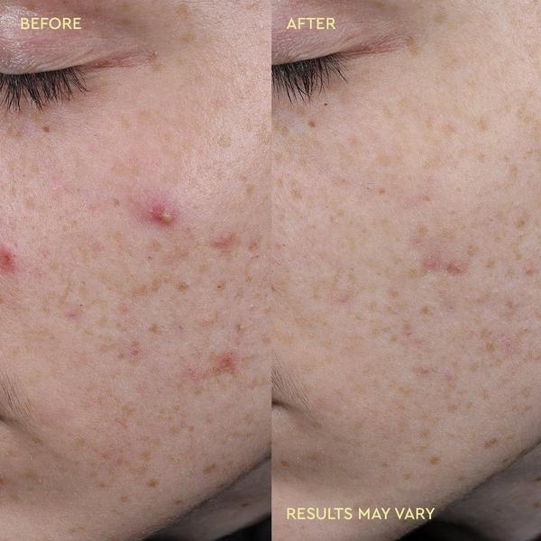 BYOMA Blemish Acne Treatment Spot Paste #5