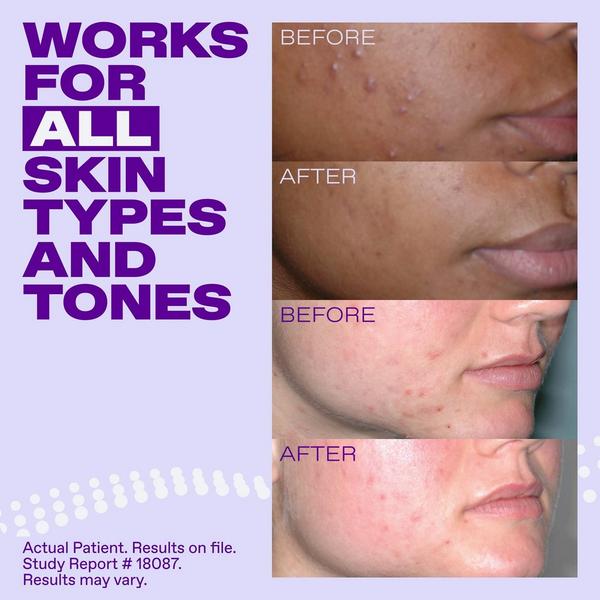 Differin Epiduo Acne Gel #6