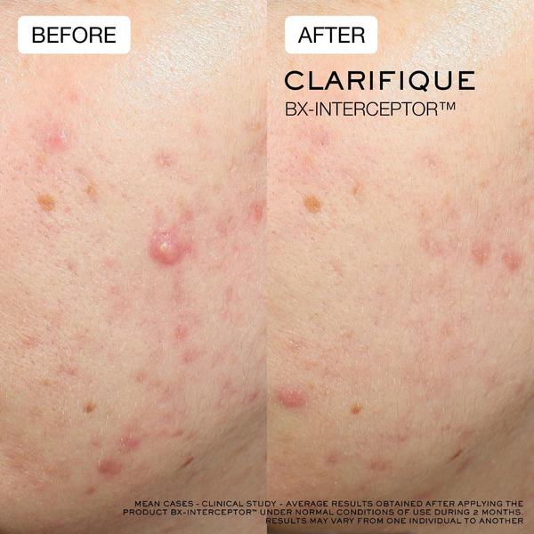 Lancôme Clarifique Bx-Interceptor Acne Treatment with Glycolic & Salicylic Acid #5