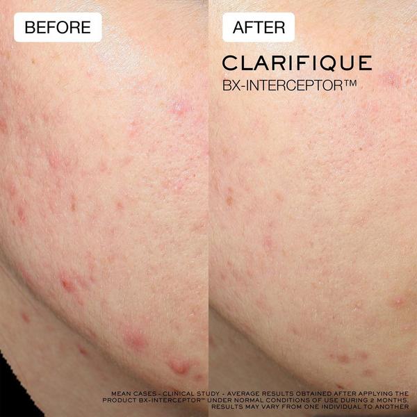 Lancôme Clarifique Bx-Interceptor Acne Treatment with Glycolic & Salicylic Acid #6