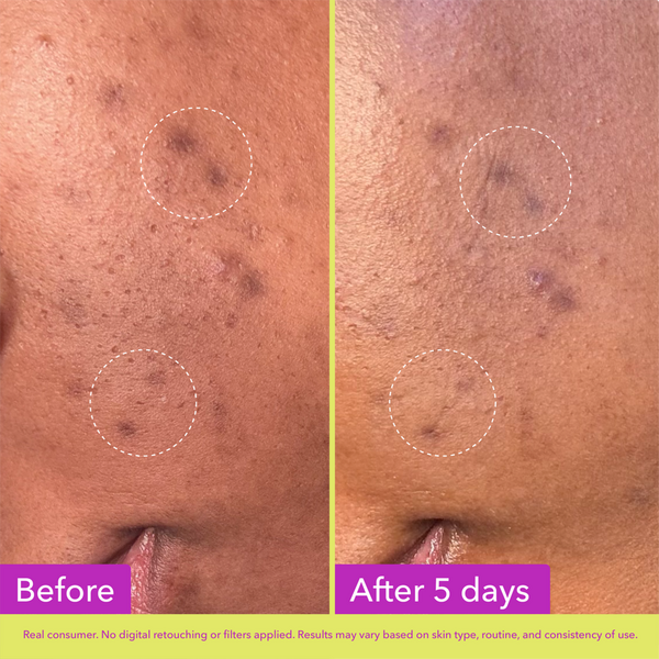 Good Molecules Dark Spot Microdart Patches #2