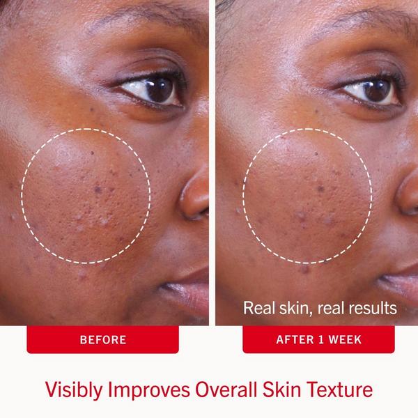 First Aid Beauty Acne Clearing Pads 2% Salicylic Acid Acne Treatment #3