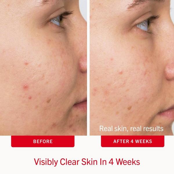 First Aid Beauty Acne Clearing Pads 2% Salicylic Acid Acne Treatment #4
