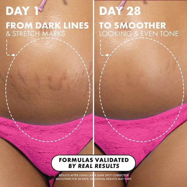 Truly Easy Tiger Stretch Mark Eraser #4