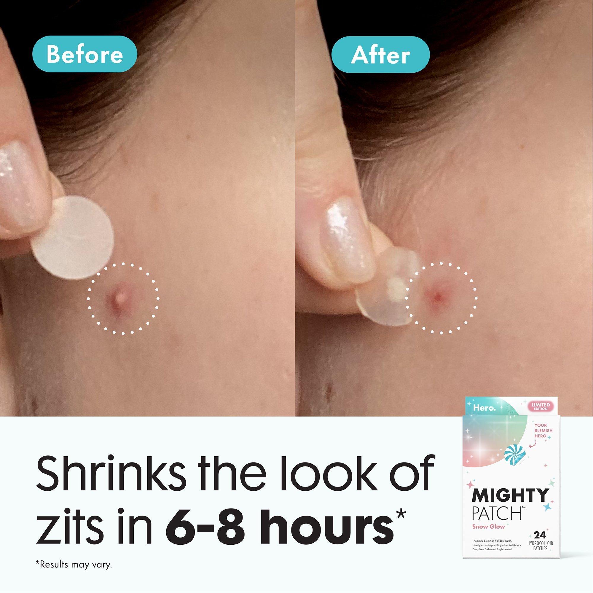 Гидроколлоидные патчи от прыщей Hero Cosmetics Mighty Patch Snow Glow, праздничная серия — фото 5