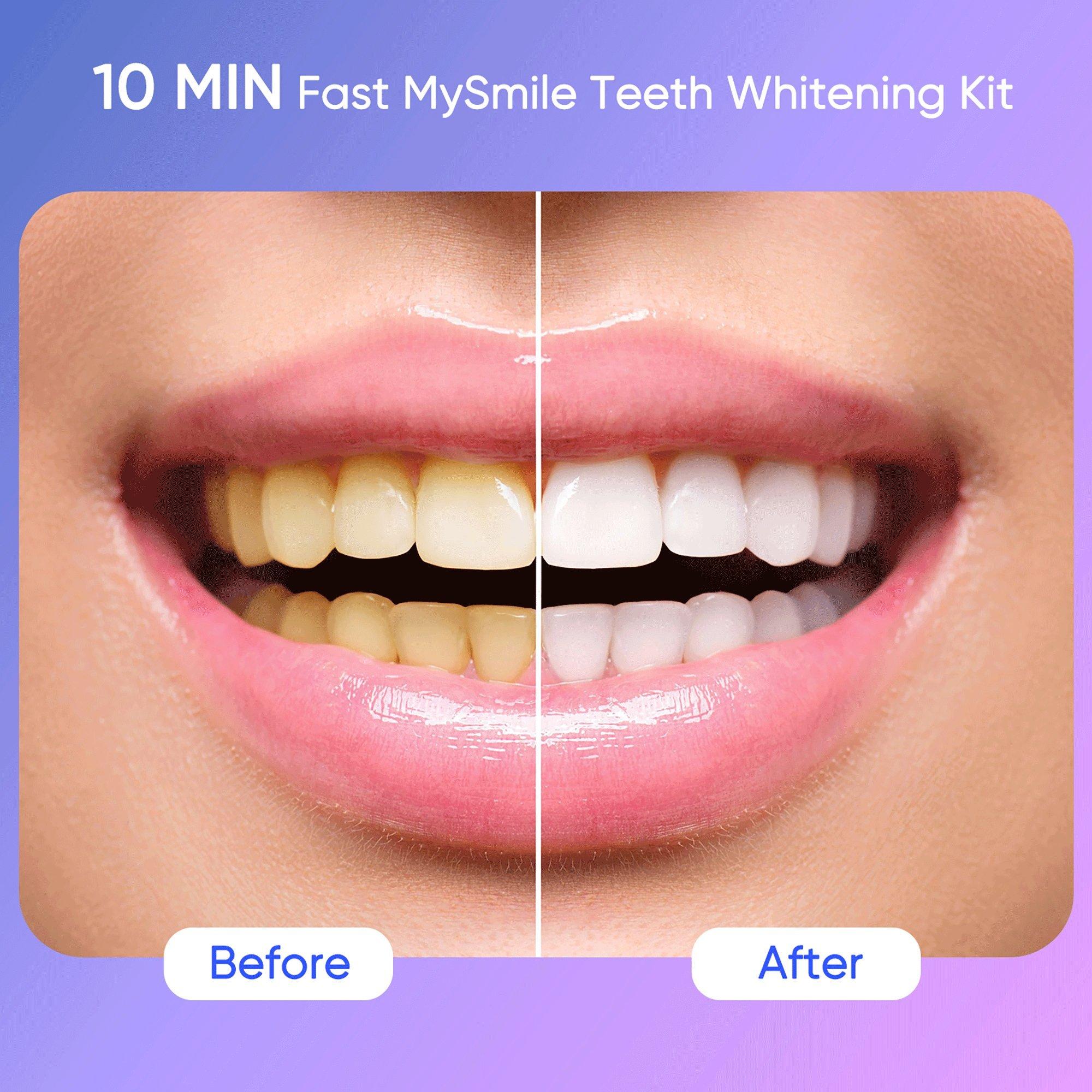 MySmile Teeth Whitening Kit - Thumbnail 5
