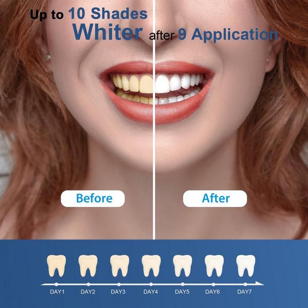 MySmile Teeth Whitening Gel Refill Pack with 18% CP #5