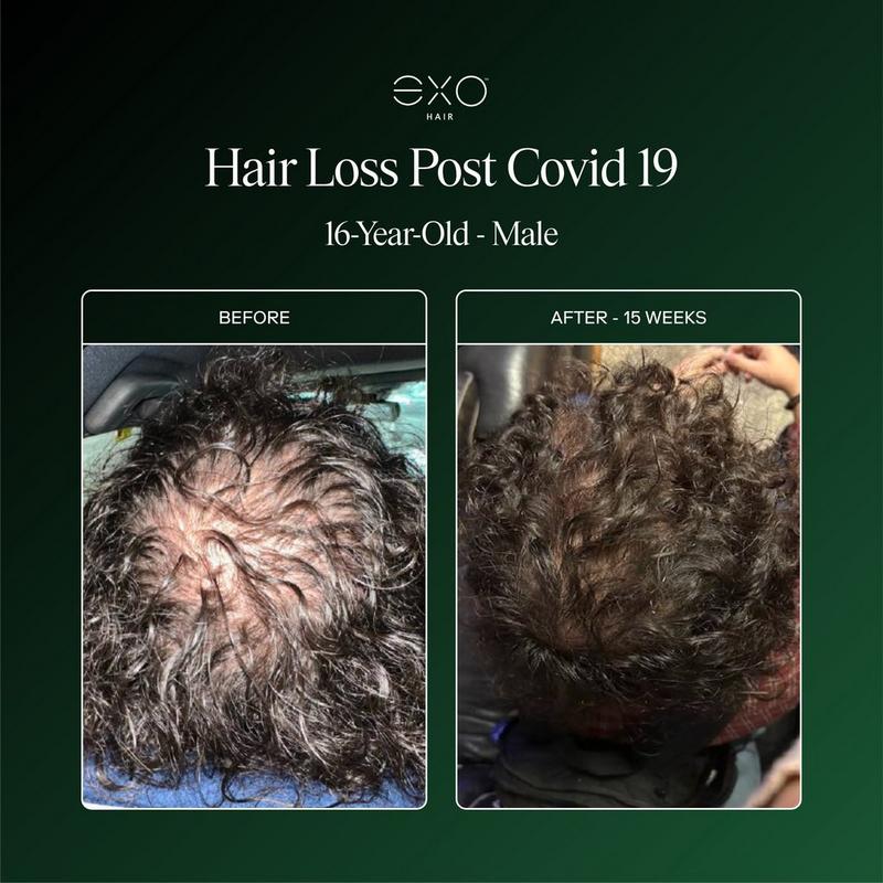 Exoceuticals - EXO FORTIFY Revitalizing Hair & Scalp Treatment