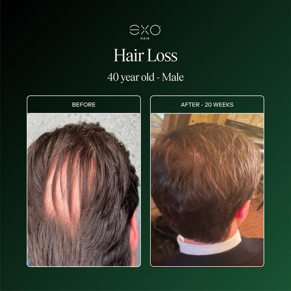 Exoceuticals EXO ACTIVATE Follicle Enrichment Serum #2