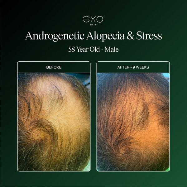 Exoceuticals EXO ACTIVATE Follicle Enrichment Serum #5