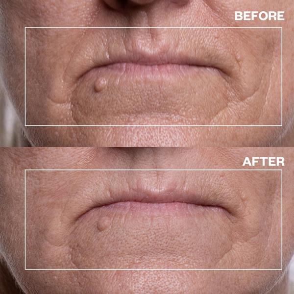 Wrinkles Schminkles Mouth & Lip Wrinkle Patches #3