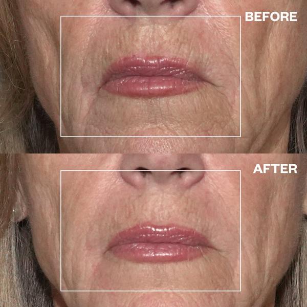 Wrinkles Schminkles Mouth & Lip Wrinkle Patch #5